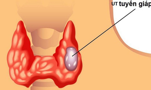 16 tuổi ung thư tuyến gi&#225;p - B&#225;c sĩ ung thư n&#243;i g&#236;?