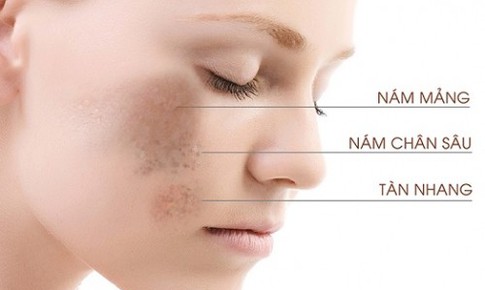 Chuyên gia chỉ ra các sai lầm khi điều trị nám