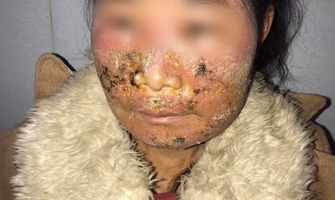 B&#244;i kem để l&#224;m đẹp kh&#244;ng ngờ dị ứng lở lo&#233;t