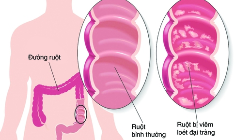 Vi&#234;m đại tr&#224;ng mạn t&#237;nh: Dễ mắc nhưng kh&#243; chữa