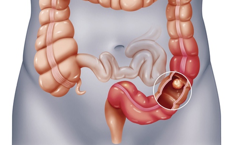 Ăn uống trong ph&#242;ng chữa ung thư ruột gi&#224;