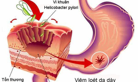 Nhiễm HP bao tử l&#224; g&#236;?