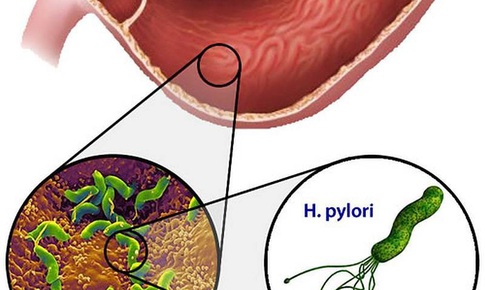 Chọn kh&#225;ng sinh diệt vi khuẩn H.Pylori hiệu quả