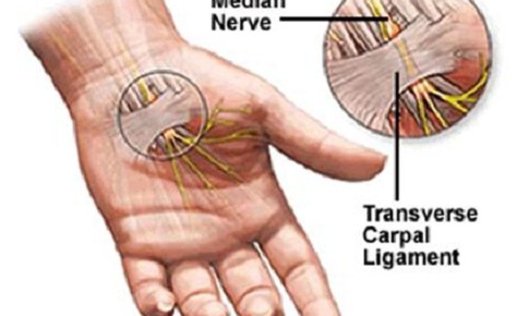 Hội chứng ống cổ tay, cần ph&#225;t hiện sớm