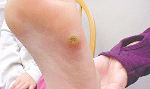 Mụn c&#243;c l&#242;ng b&#224;n ch&#226;n - bệnh l&#226;y nhiễm do đi ch&#226;n trần