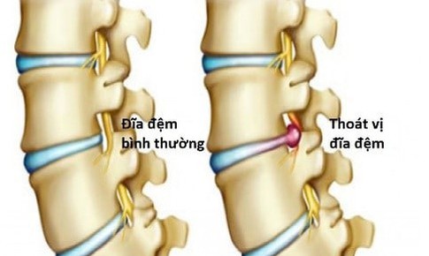 Chế tạo th&#224;nh c&#244;ng đĩa đệm cột sống sinh học