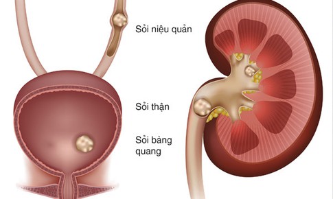 Mắc bệnh xốp thận cần lưu ý gì?