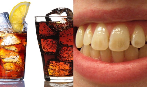 Xử lý đốm trắng trên răng