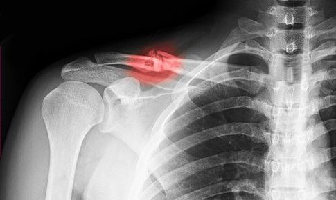 Gãy xương đòn, nên điều trị bảo tồn hay phẫu thuật?