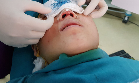 Dùng kim và dòng điện để chỉnh sửa mũi trong 5 phút