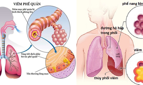 Chứng phong &#244;n v&#224; thuốc trị