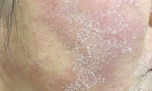 Tự hủy hoại làn da bằng kem làm đẹp thần tốc