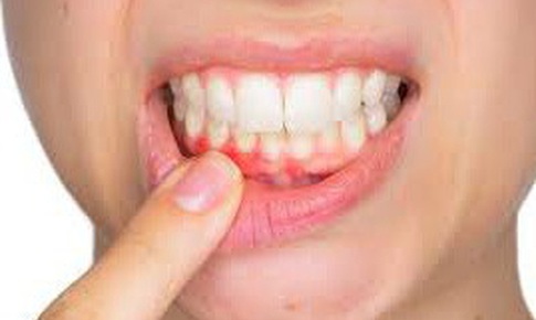 Viêm nướu răng - Chớ coi thường!