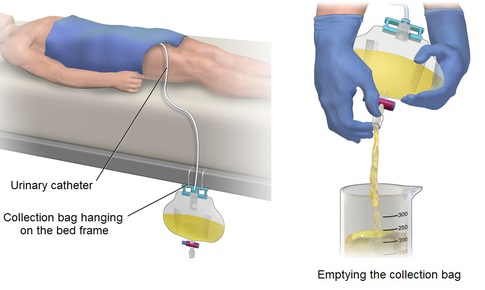 Chăm s&#243;c người bệnh mang dẫn lưu b&#224;ng quang tại nh&#224;