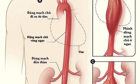 Nguy&#234;n nh&#226;n ph&#236;nh b&#243;c t&#225;ch động mạch chủ