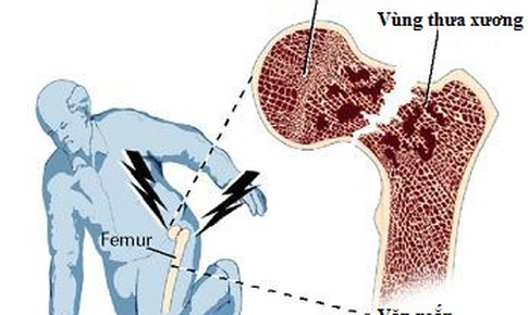 Tr&#225;nh nguy cơ g&#227;y xương v&#249;ng khớp h&#225;ng ở người cao tuổi