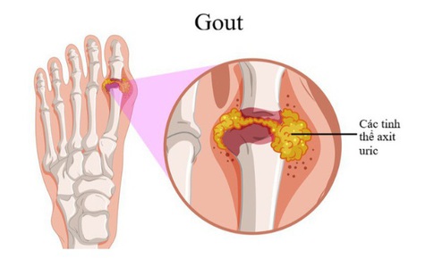 B&#224;i thuốc th&#244;ng kinh lạc, khu phong trị bệnh g&#250;t