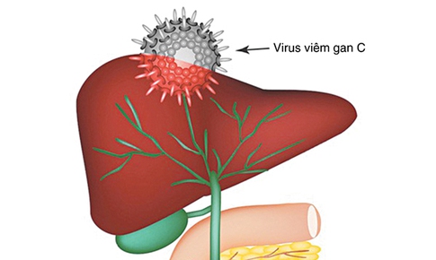 Vi&#234;m gan si&#234;u vi C nguy hiểm đến mức n&#224;o?