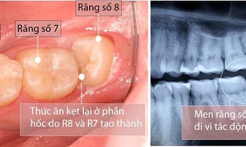 Răng số 8 hay mọc lệch, v&#236; sao?