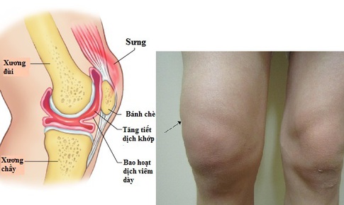 Vi&#234;m điểm b&#225;m g&#226;n v&#224; tr&#224;n dịch khớp c&#243; nguy hiểm?