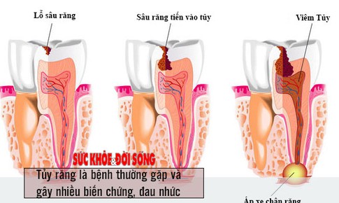 Lấy tủy về răng rất đau