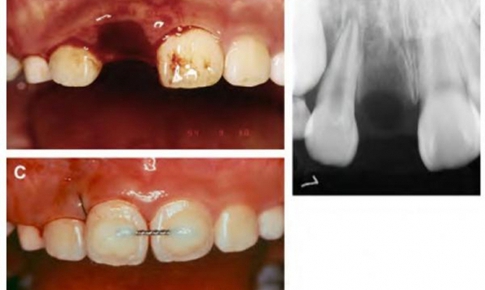 Răng rơi ra khỏi miệng, c&#243; gắn lại như cũ được kh&#244;ng?