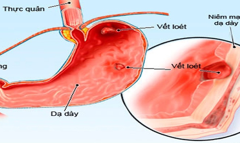 Thuốc tốt từ dạ d&#224;y nh&#237;m