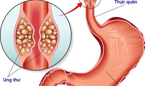 Thực quản tổn thương c&#243; thể g&#226;y ung thư?