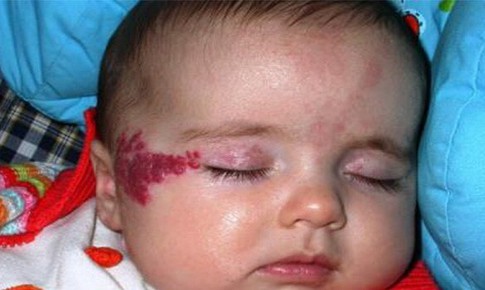 Khi con bị u máu sơ sinh, nên làm gì?
