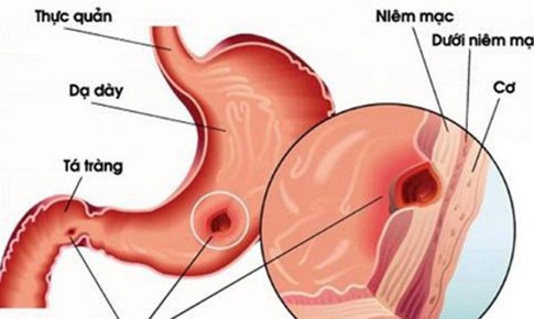 C&#243; n&#234;n đổi thuốc băng se ni&#234;m mạc dạ d&#224;y