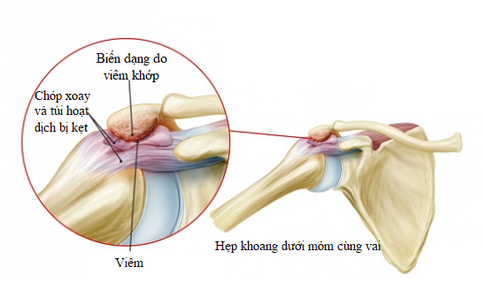 Đau vai do hẹp khoang dưới mỏm cùng vai