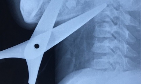 Cứu sống bé trai bị kéo đâm xuyên cổ