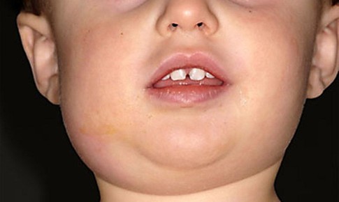 Mùa xuân, đề phòng bệnh quai bị ở trẻ