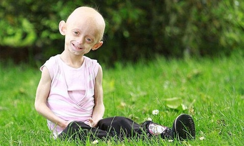 Hội chứng Progeria: Giải m&#227; b&#237; ẩn của những đứa trẻ “gi&#224; sớm”