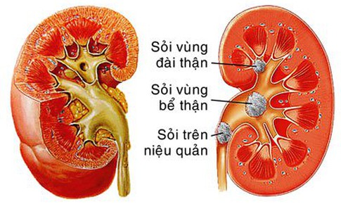 B&#224;i thuốc ph&#242;ng v&#224; trị sỏi đường tiết niệu