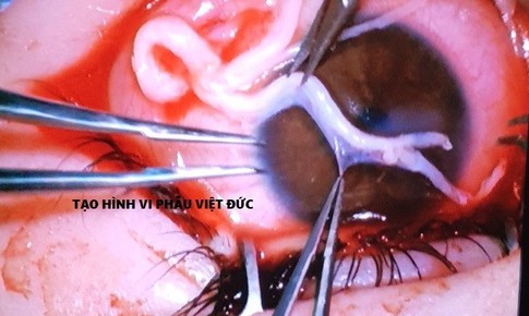Kỹ thuật mới 'giải thoát' mù loà cho bệnh nhân loét giác mạc do mất cảm giác