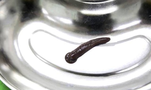 Kinh hoàng: Đỉa trâu 10cm, to bằng ngón tay sống trong cổ họng người đàn ông