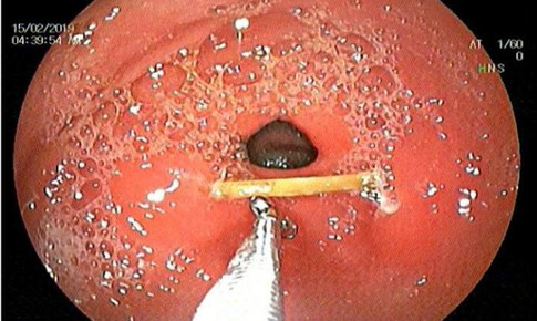 Xỉa răng "bỏ quên" cây tăm 3cm, bắc ngang dạ dày người phụ nữ