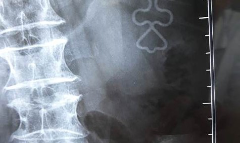 Cụ bà đau thắt lưng, hóa ra vòng tránh thai "đi lạc" tới ổ thận trái