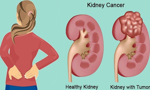 Đau thắt lưng &#226;m ỉ, c&#243; thể bạn đ&#227; mắc ung thư thận