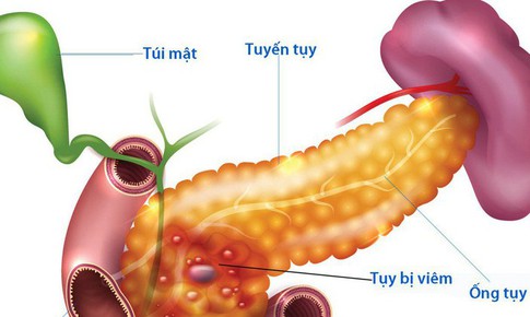 Nguyên nhân gây viêm tụy mạn tính