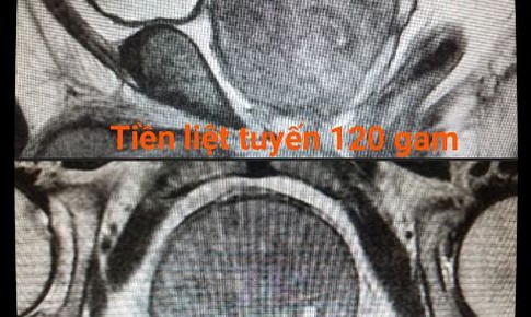 Cứu cụ &#244;ng c&#243; khối tiền liệt tuyến &quot;si&#234;u to, khổng lồ&quot; khỏi chứng tiểu đ&#234;m