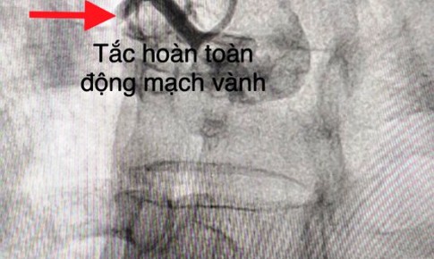 Cảnh b&#225;o cơn đau ngực dữ dội c&#243; thể g&#226;y tử vong nhanh ch&#243;ng