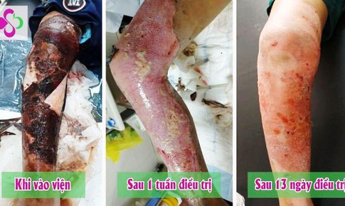 Bị bỏng không đi khám, tự bôi thuốc sát trùng khiến con trai hoại tử chân