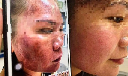 Da mặt “cháy đen” vì tự bôi thuốc trị nám, trứng cá mua online