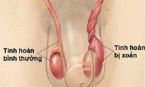 Nam giới chớ chủ quan với xoắn tinh hoàn