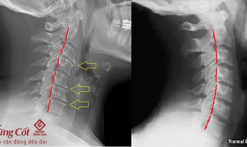 Điều trị tận gốc bệnh tho&#225;i h&#243;a đốt sống cổ, kh&#244;ng để lại di chứng