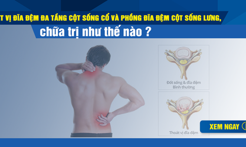 Tho&#225;t vị đĩa đệm đa tầng cột sống cổ v&#224; phồng đĩa đệm cột sống lưng, chữa trị thế n&#224;o?