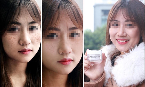 Sản phẩm làm sạch nám sáng da được săn lùng ráo riết