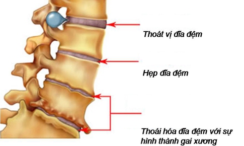 Thoái hóa cột sống và phương pháp đẩy lùi